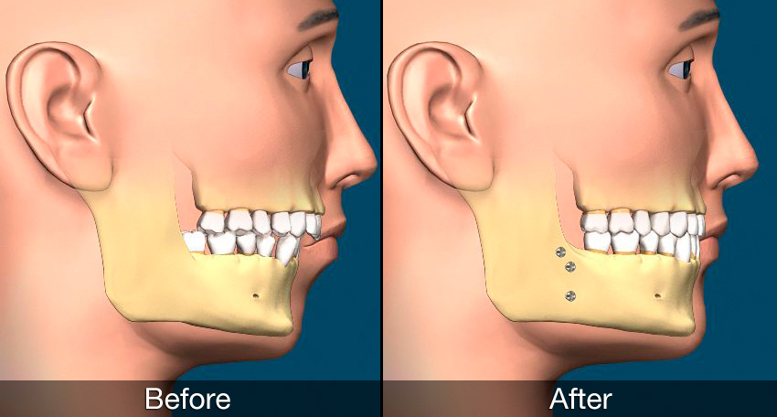 Orthognathic Surgery The Smile Clinic