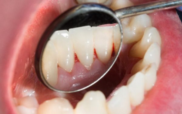 6 Signs That You Should Probably See a Dentist - The Smile Clinic